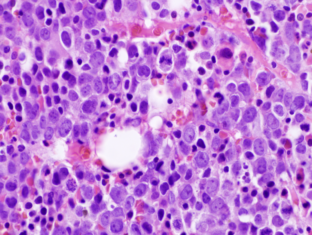 Bone marrow core biopsy 600x